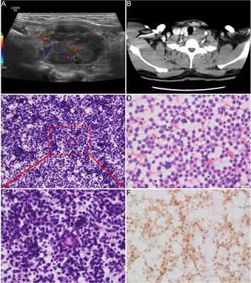 Primary Thyroid NUT Carcinoma With High PD-L1 Expression and Novel Massive IGKV Gene Fusions: A Case Report With Treatment Implications and Literature Review